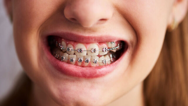 Kiedy najlepiej rozpocząć leczenie ortodontyczne u dorosłych?